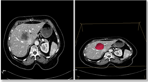 CT像からの転移性肝がんの検出